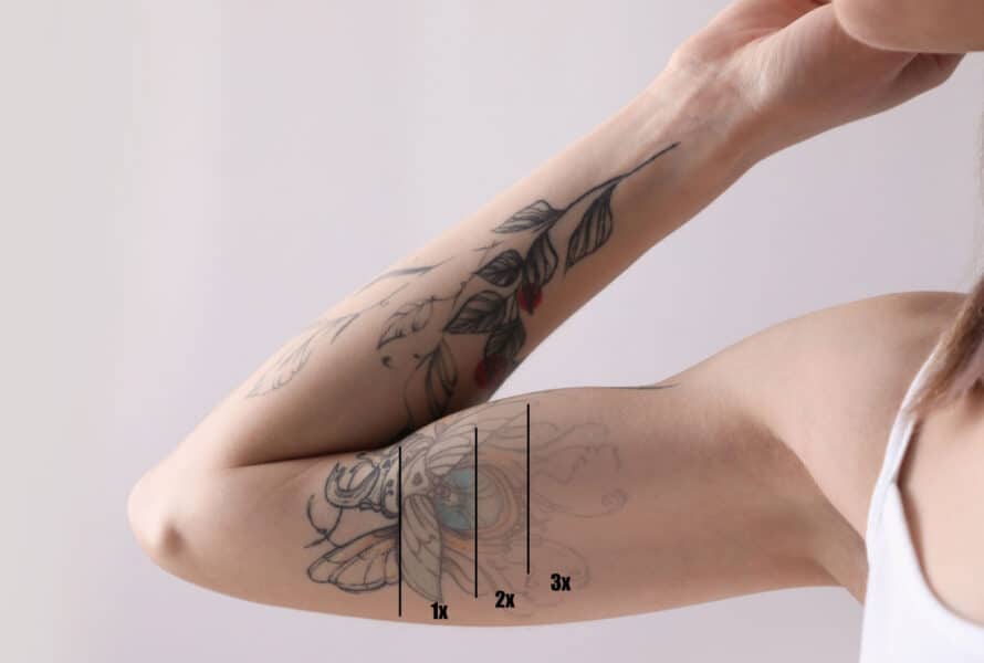 Détatouage – Laser Picoseconde Enlighten
