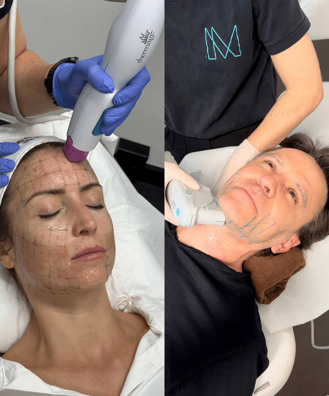 Synergy Lift : Ulthera Prime et Thermage pour un lifting sans chirurgie | Matignon