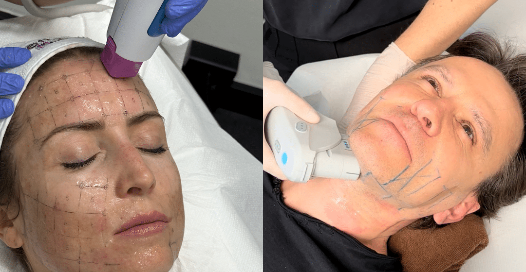 Synergy Lift : Ulthera Prime et Thermage pour un lifting sans chirurgie | Matignon